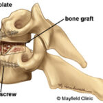 Anterior Cervical Fusion Surgery nj