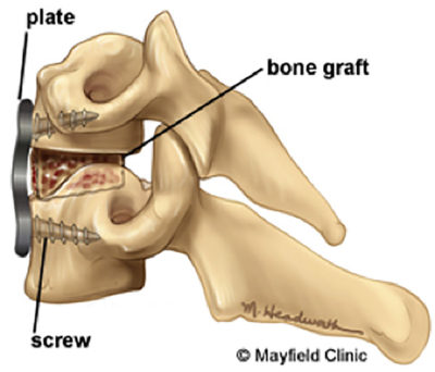 Anterior Cervical Fusion Surgery nj