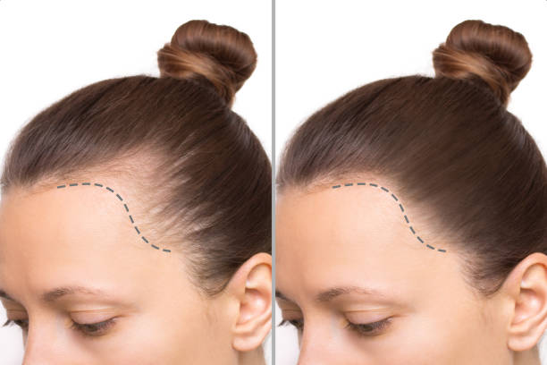 زراعة الشعر المنظمة