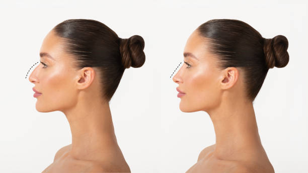 Refined Nasal Contouring